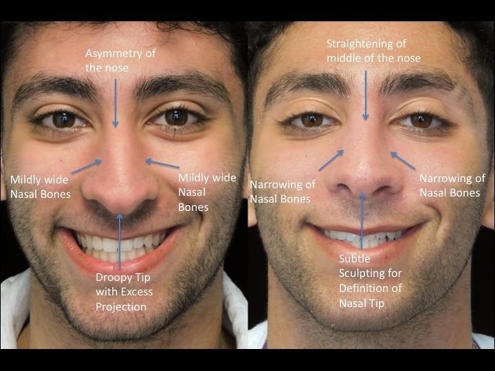 what is a closed rhinoplasty