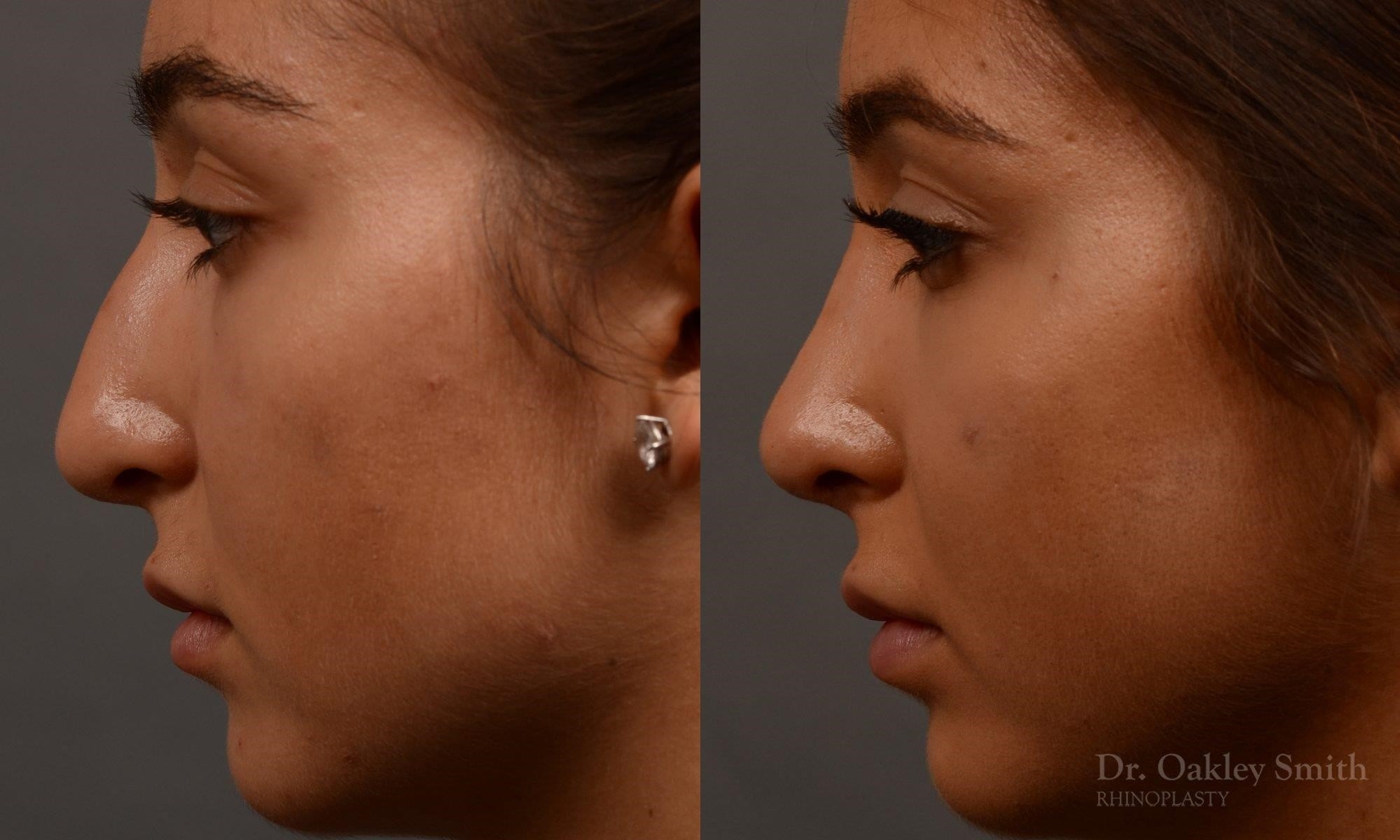 closed rhinoplasty near me