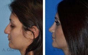 rhinoplasty expert nyc