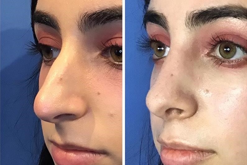 closed rhinoplasty near me