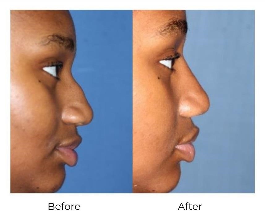 rhinoplasty expert nyc